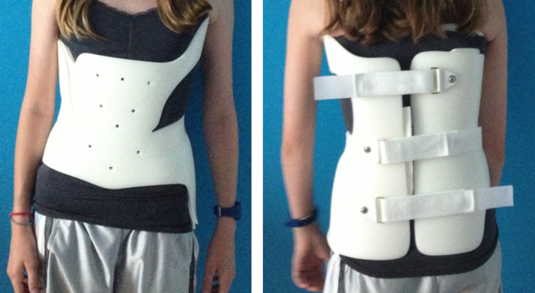 SCOLIOSIS BRACE SYSTEM K.K. Prosthetic & Orthopaedic Equipment