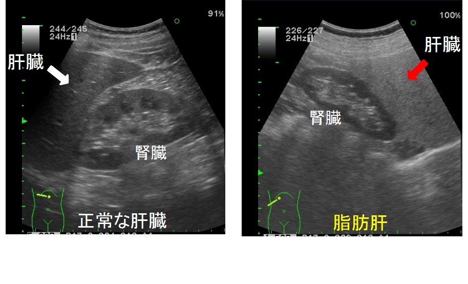 腹部エコー（超音波検査）初心者が、最低限知っておきたいよく遭遇する代表的な疾患