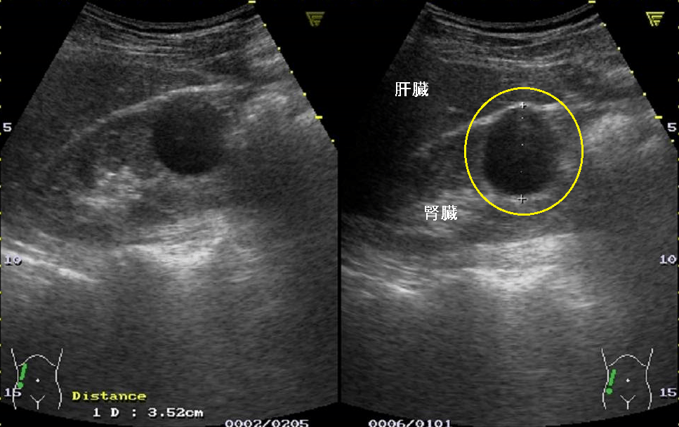 膵臓、脾臓、腎臓のエコー（超音波）画像の見方・疾患とその所見