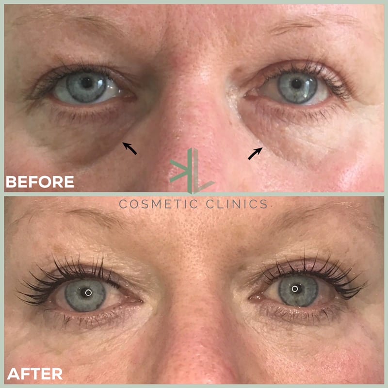 Tear trough fillers Treating tiredlooking eyes KL Cosmetic Clinics