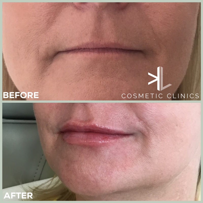 Natural lip enhancement Subtle lip fillers KL Cosmetic Clinics