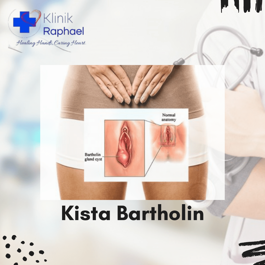 Kista Bartholin