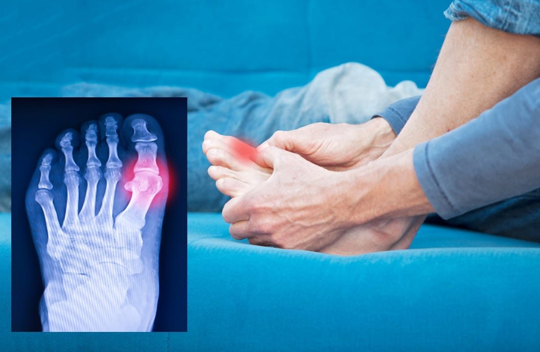 Radang Sendi (Gout Arthritis)