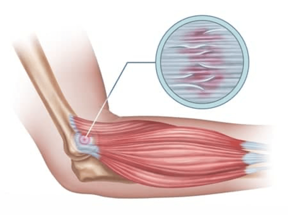 Mengatasi Pegal / Nyeri Otot Akibat DOMS Setelah Berolahraga