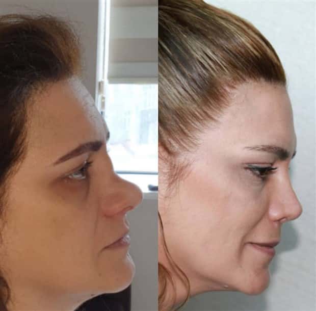 23 Insane Plastic Surgery Face Transformations