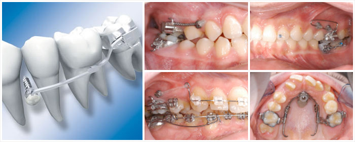 Orthodontische Miniimplantate Knak + Venhoff