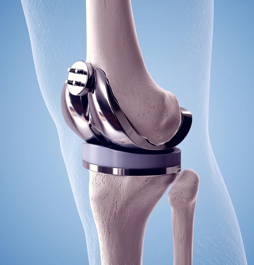 How will my knee feel after a TKR? Knee Replacement Centurion Orthopaedic Centre