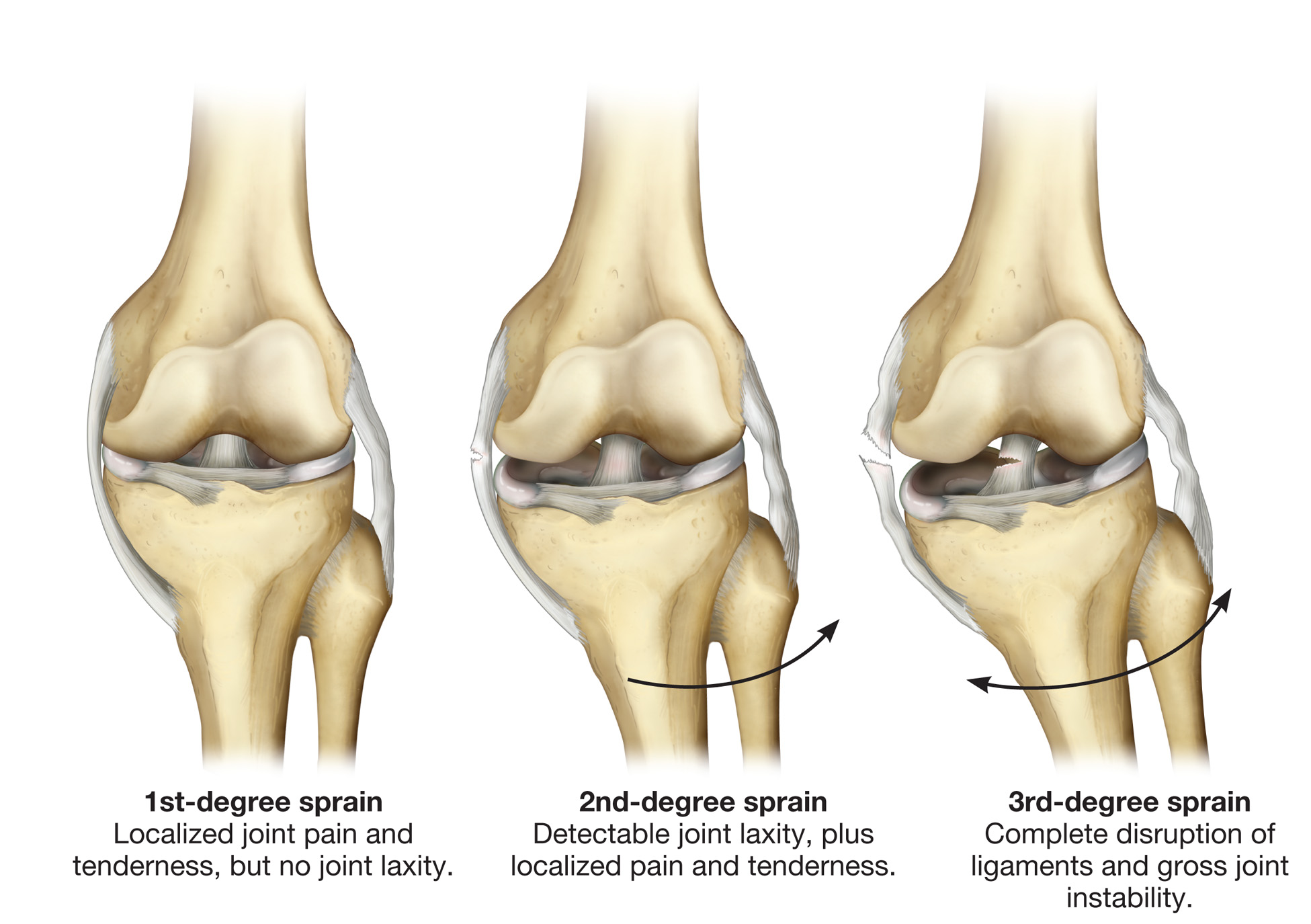 The most common knee injuries and disorders