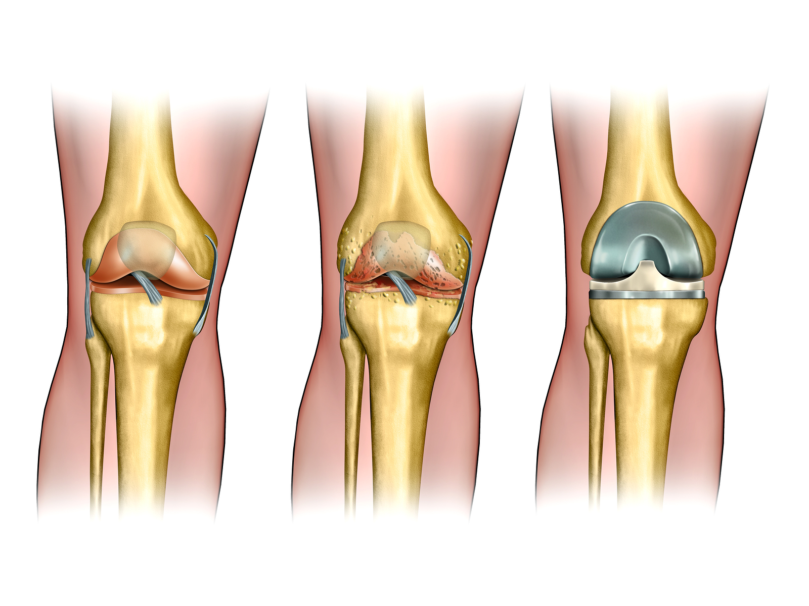 Knee replacement surgery