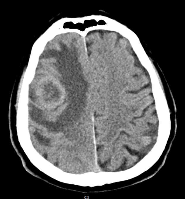 Q 2.22. Cerebral tumors classification, clinical symptoms, diagnosis