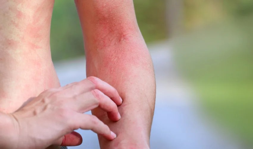 Drug Allergy Defined From Signs to Solutions KnowlesWellness