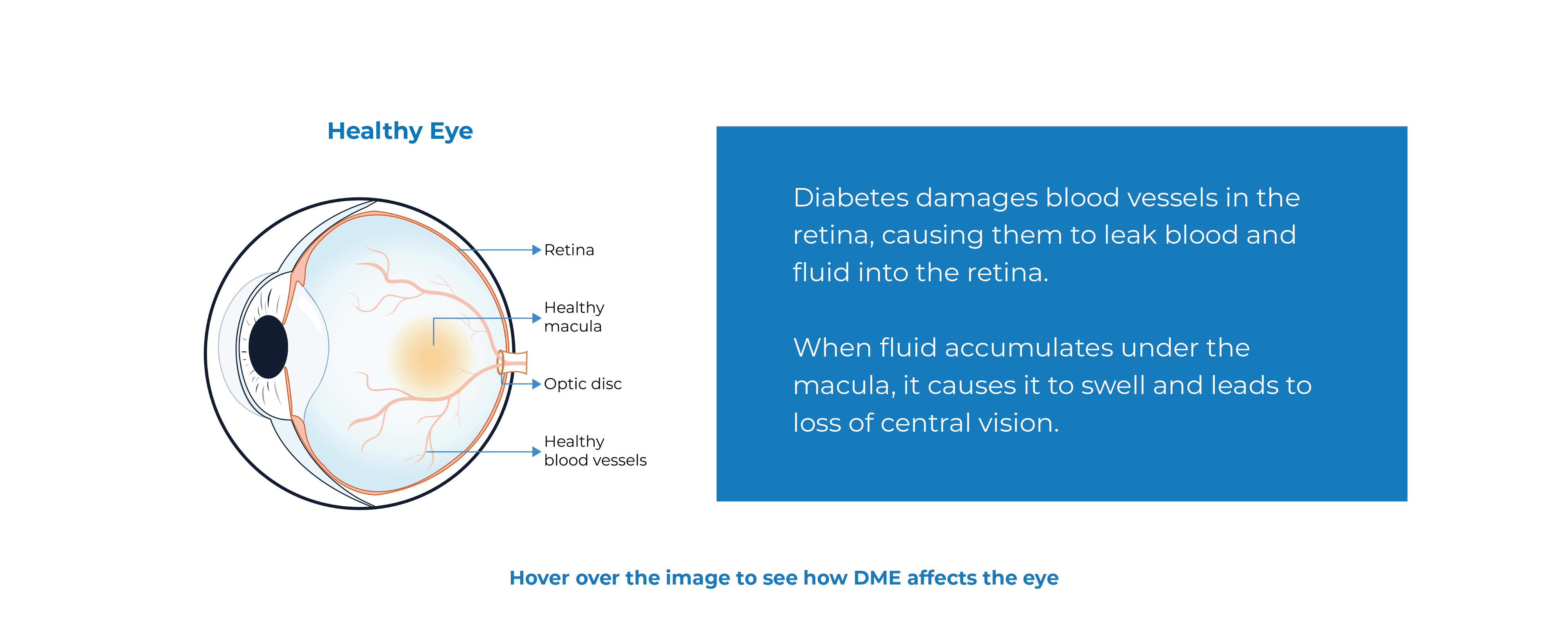 DME Diabetic Macular Edema Kodiak Sciences
