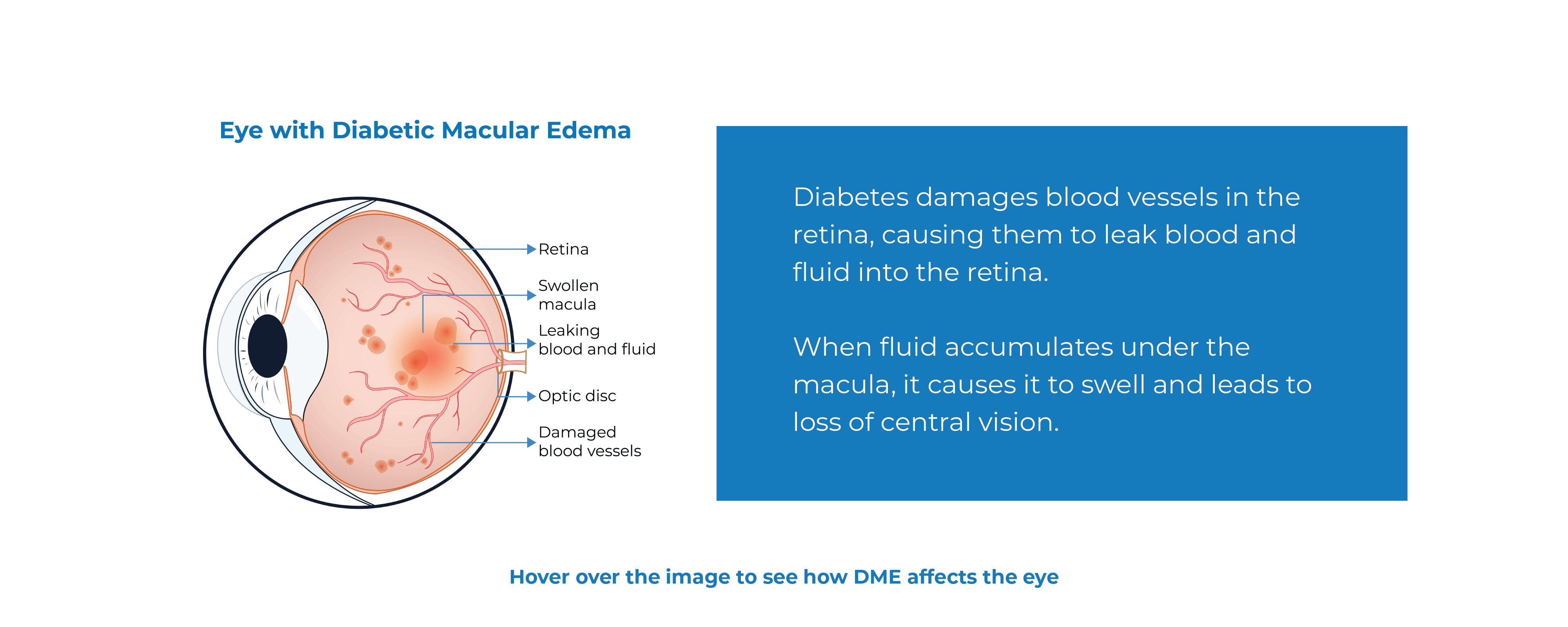 DME Diabetic Macular Edema Kodiak Sciences