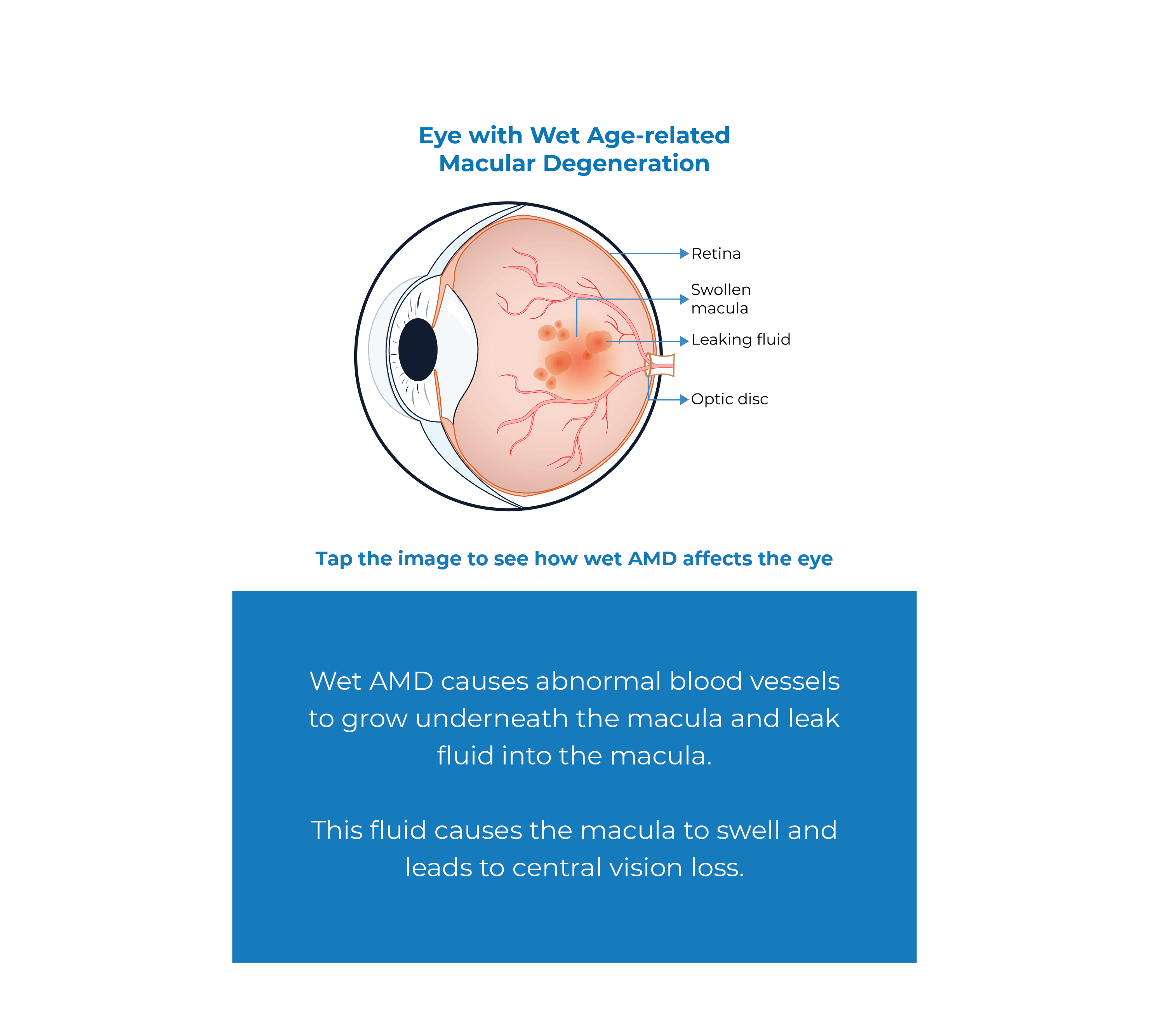 WAMD Wet Age Related Macular Degeneration Kodiak Sciences