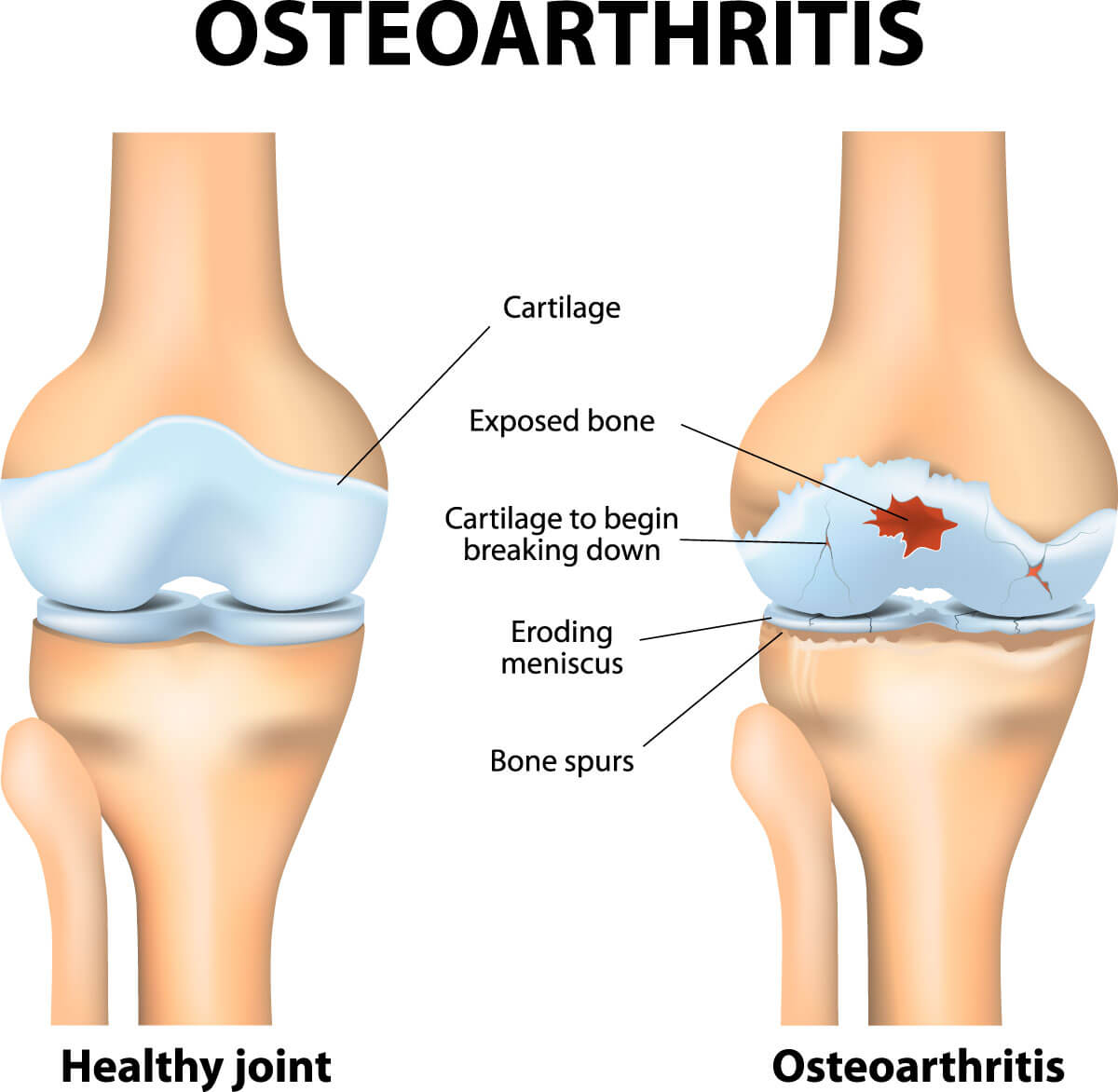 Top 32+ Stock Photos picture of swollen knee due to arthritis Superb