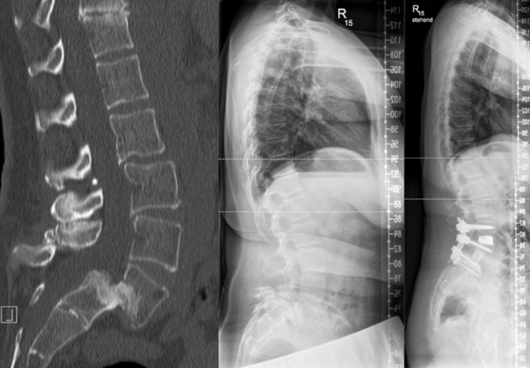 Spondylolisthese Koller Wirbelsäule Ihr Spezialist für Deformitäten