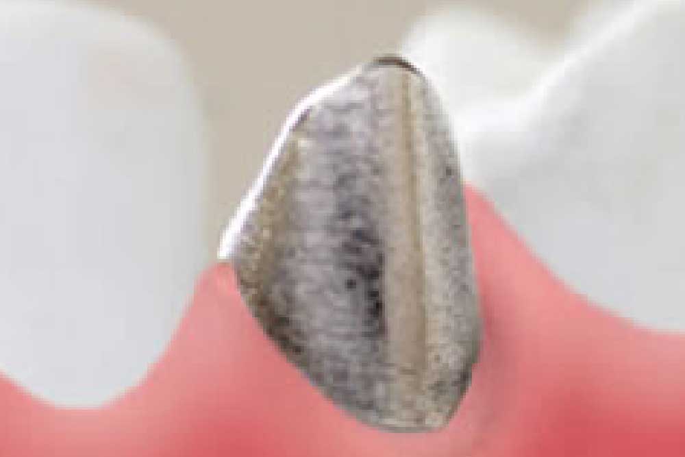 つめ物・かぶせ物｜セラミック審美治療｜世田谷区千歳烏山のこまい歯科