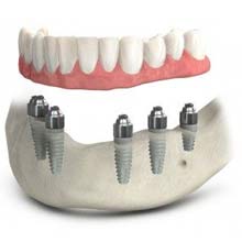 Affordable Dentures In Leeds Alabama | Koplon Implant & Family Dentistry