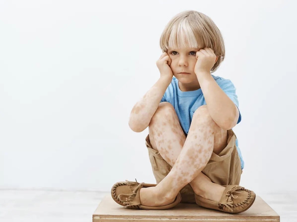 Does White Spots on Skin Actually Come from Sun Exposure Korabeauticals