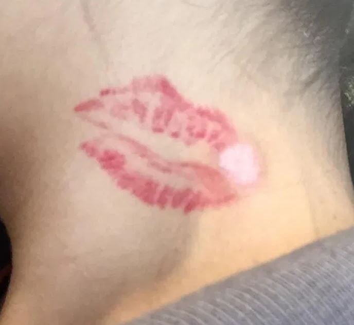 Die ** Tattooentfernung ** als Alternative zu ** Tattoo lasern** im