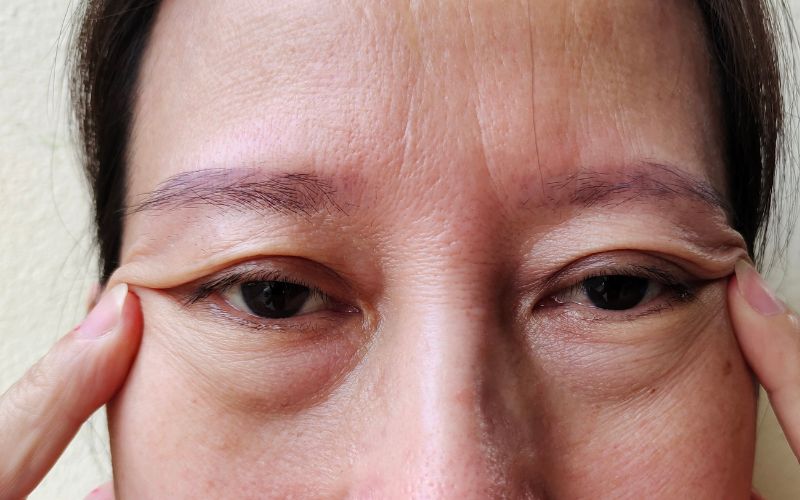 Is Eye Bag Removal Permanent? Kowayo Aesthetic Clinic Singapore