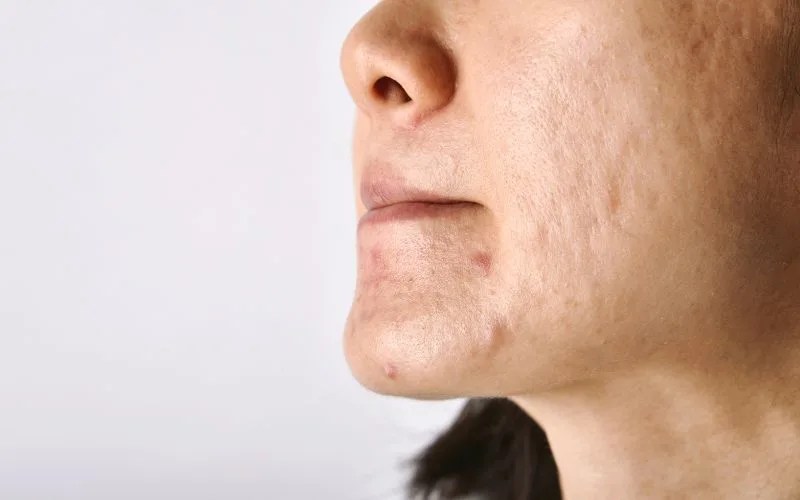 Acne Scar Treatments in Singapore A Guide to NonInvasive Options