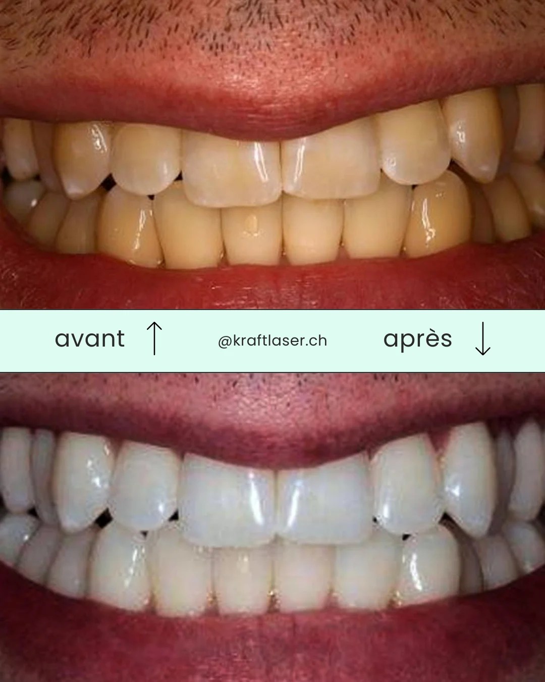 Blue LED Teeth Whitening Dernière génération et prix imbattable