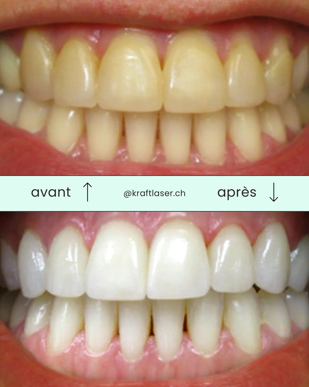 Blue LED Teeth Whitening Dernière génération et prix imbattable