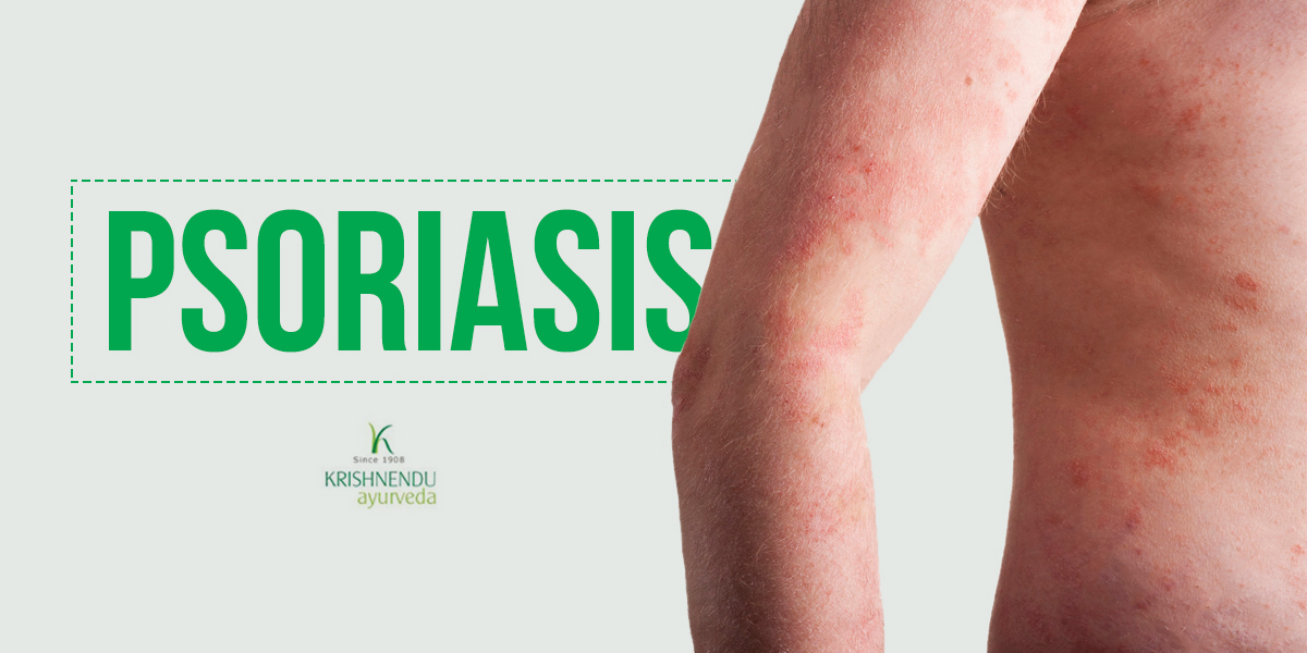 Ayurvedic Tretament and Home remedies for Psoriasis Ayurvedic