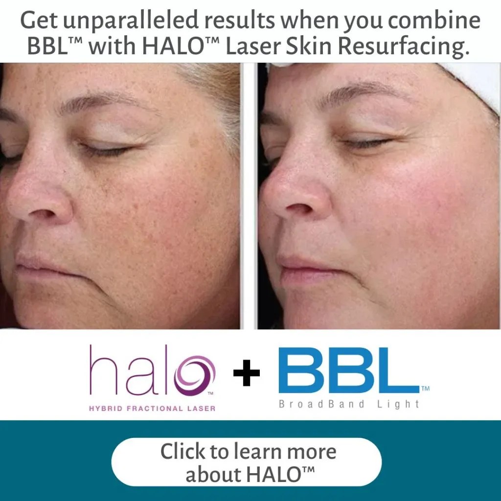 Forever Clear BBL® Acne Treatment Ooh La La Med Spa