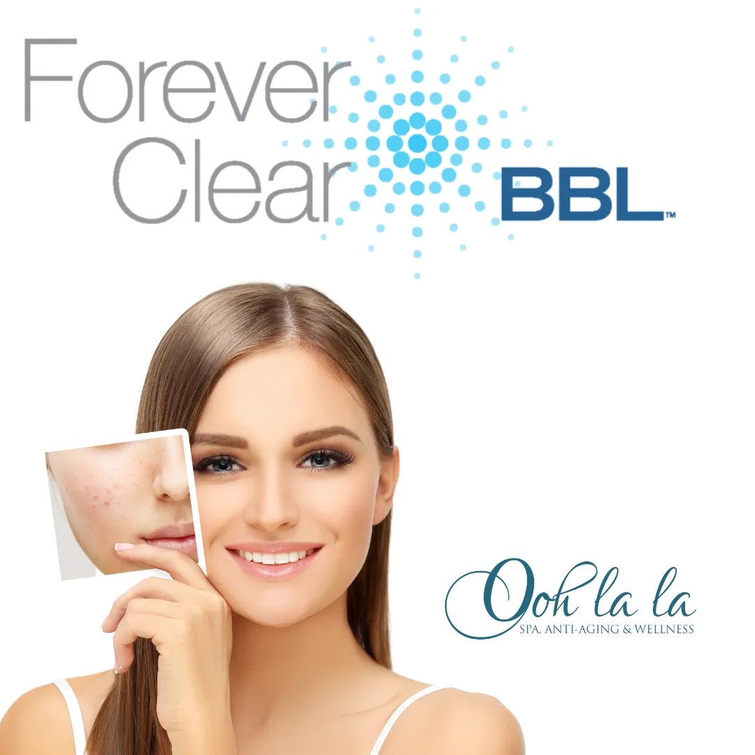 Forever Clear BBL® Acne Treatment Ooh La La Med Spa