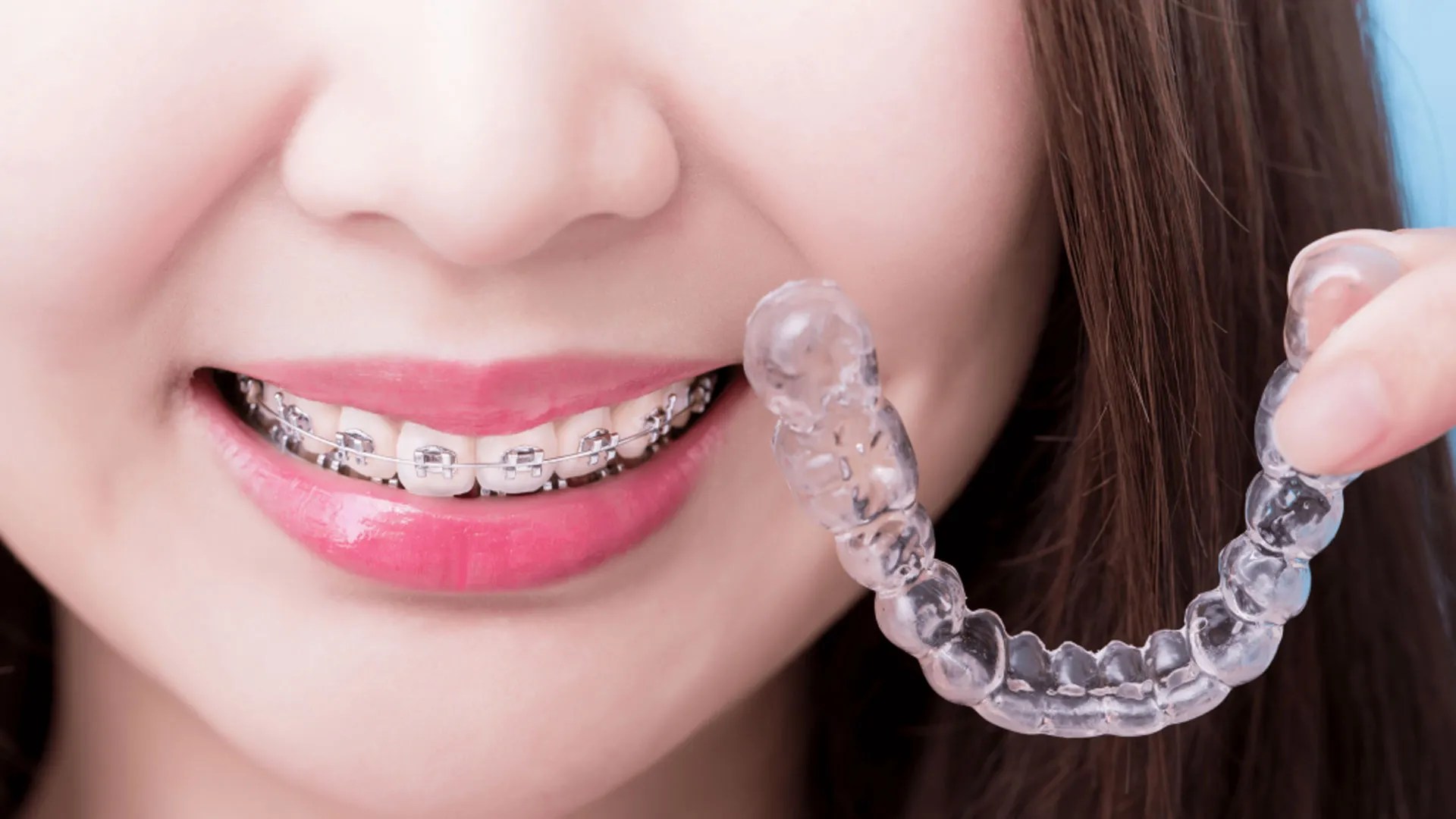 Braces Vs Invisalign What's Best For Me? King Street Dental Warrawong