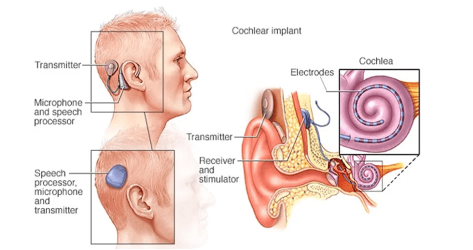 What are cochlear implants and how do they work?