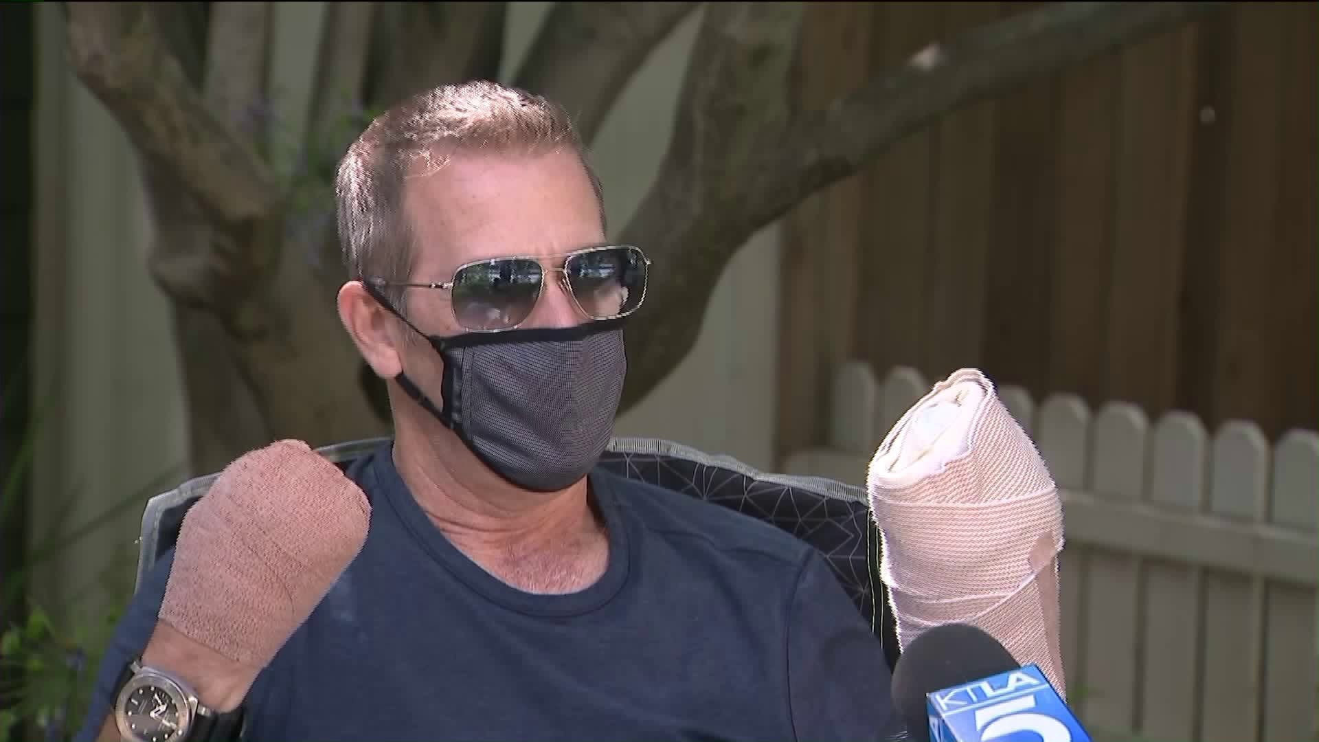 COVID19 survivor who spent 64 days in Burbank hospital, had most of his fingers amputated