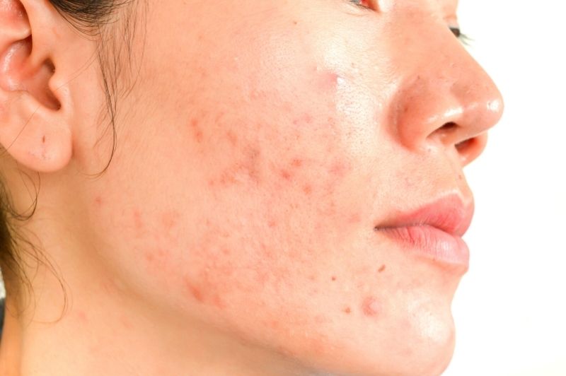 Adult Acne Why It’s Normal And How To Treat It Kuel Life