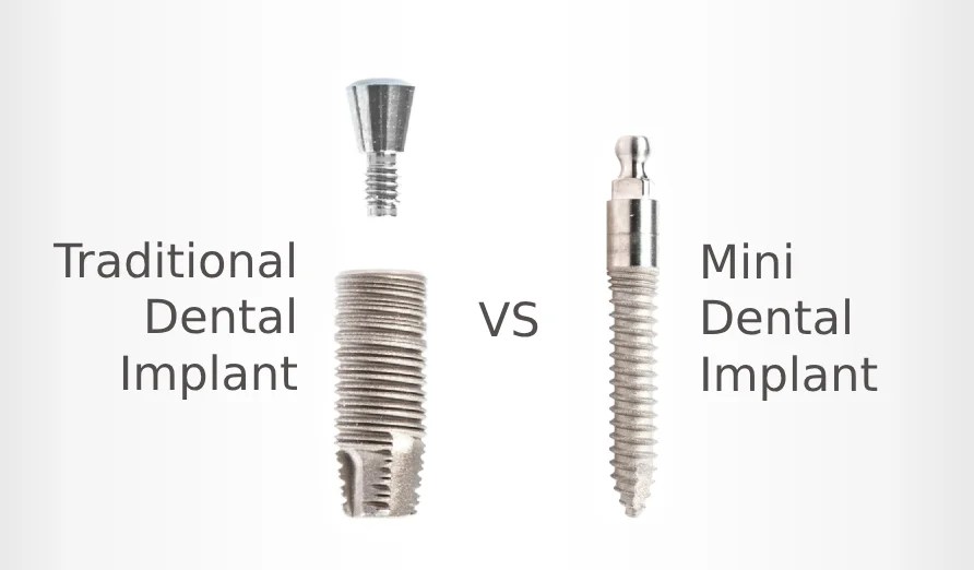 Mini Implants vs Regular Implants A Comprehensive Comparison Kuljic