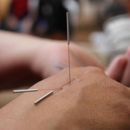 Does acupuncture work to stop smoking?