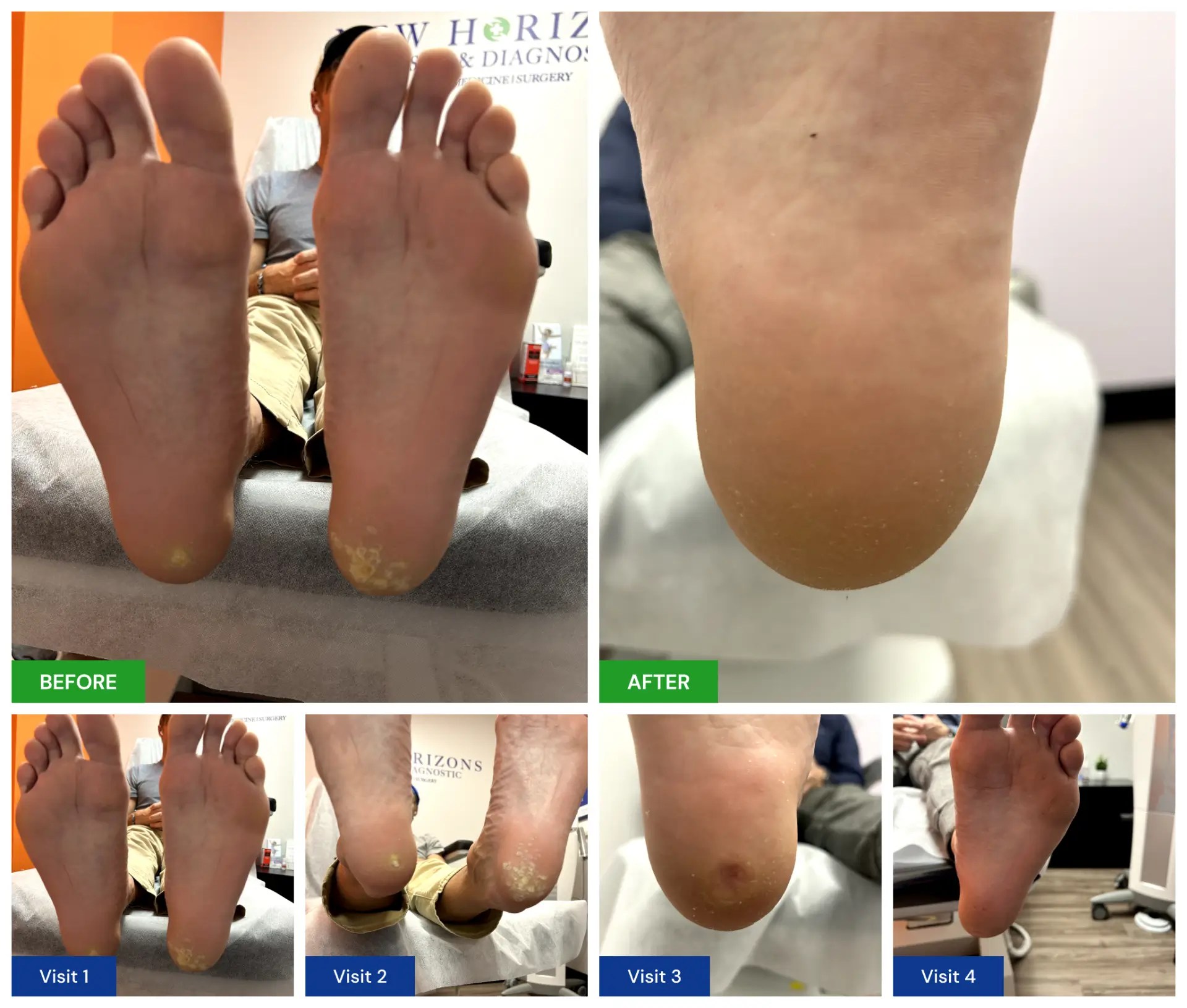 Plantar Wart Treatment New Horizons Foot and Ankle Associates
