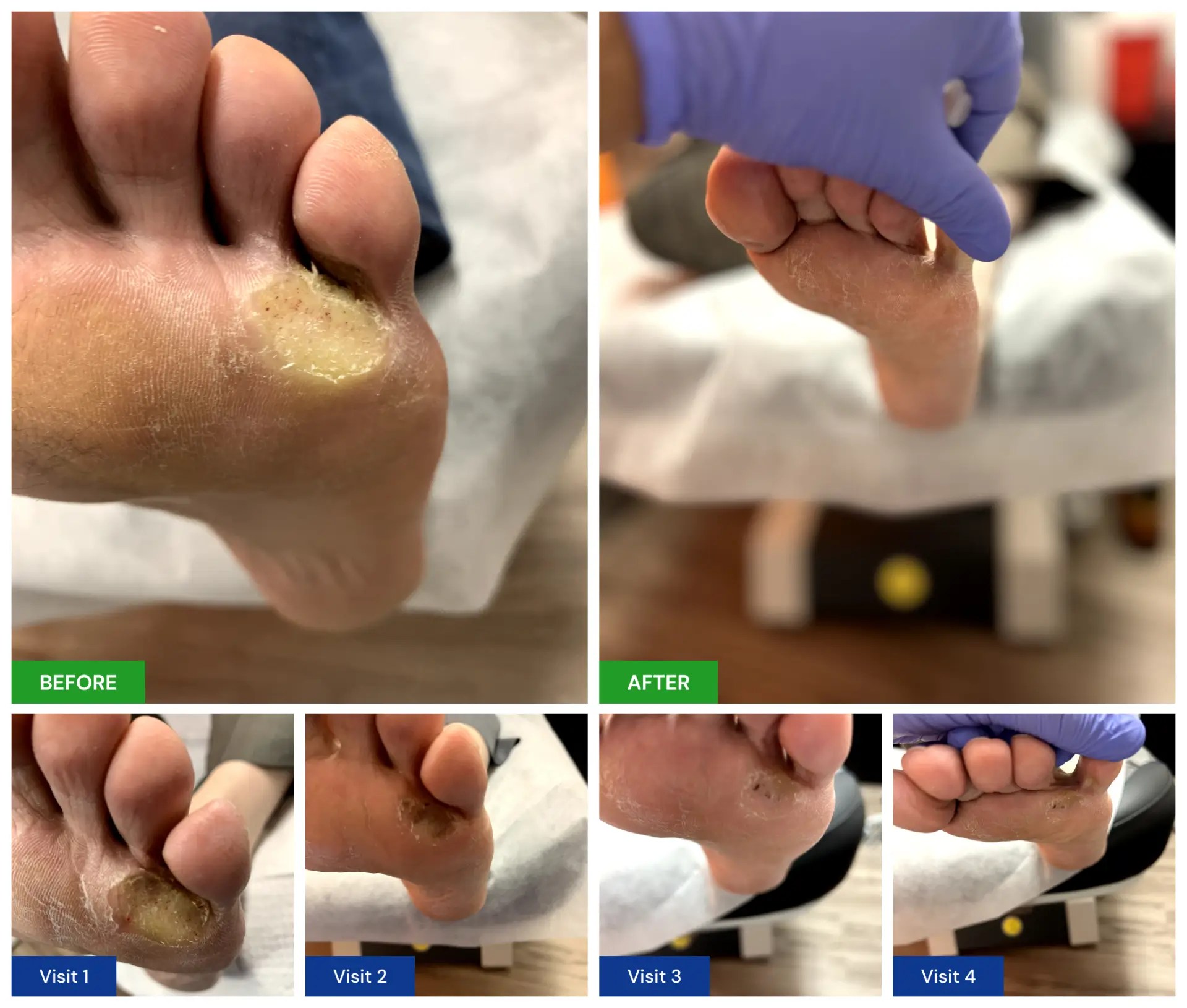 Plantar Wart Treatment New Horizons Foot and Ankle Associates