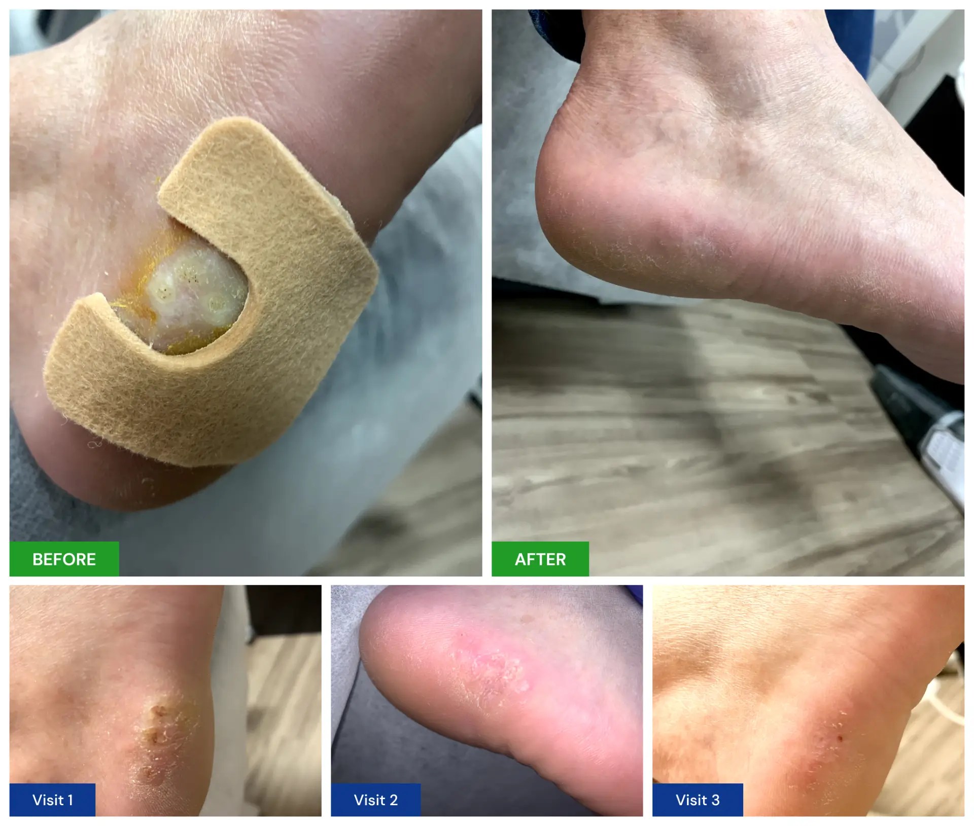 Plantar Wart Treatment New Horizons Foot and Ankle Associates