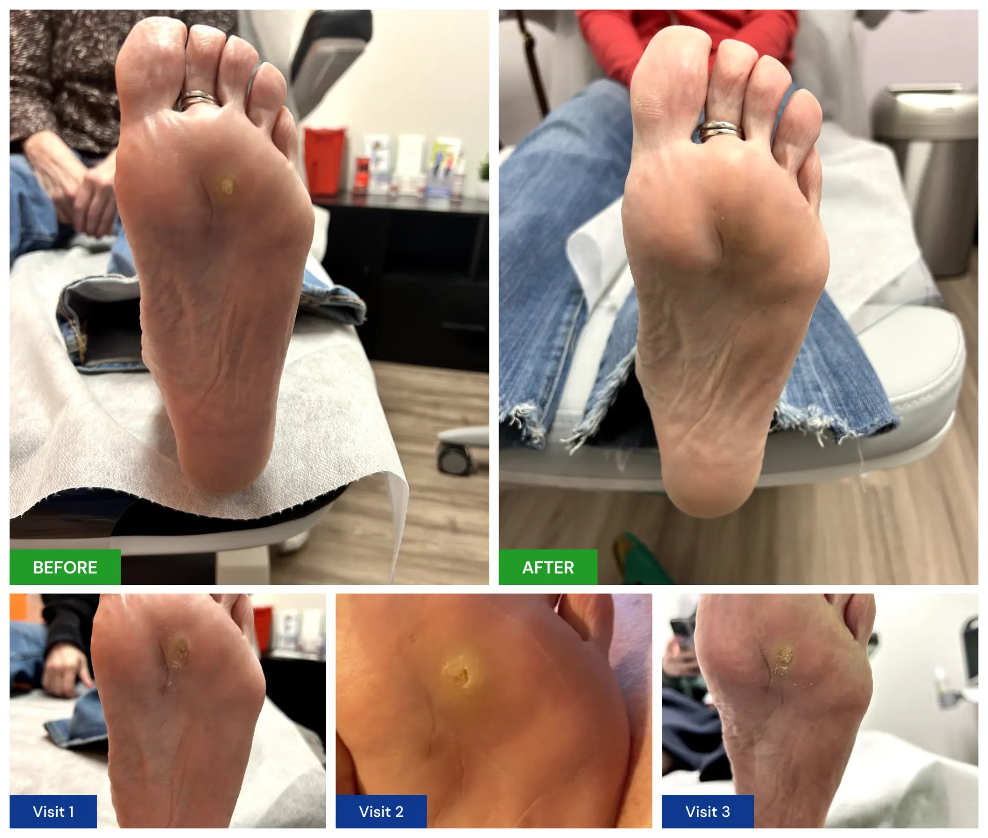 Plantar Wart Treatment New Horizons Foot and Ankle Associates