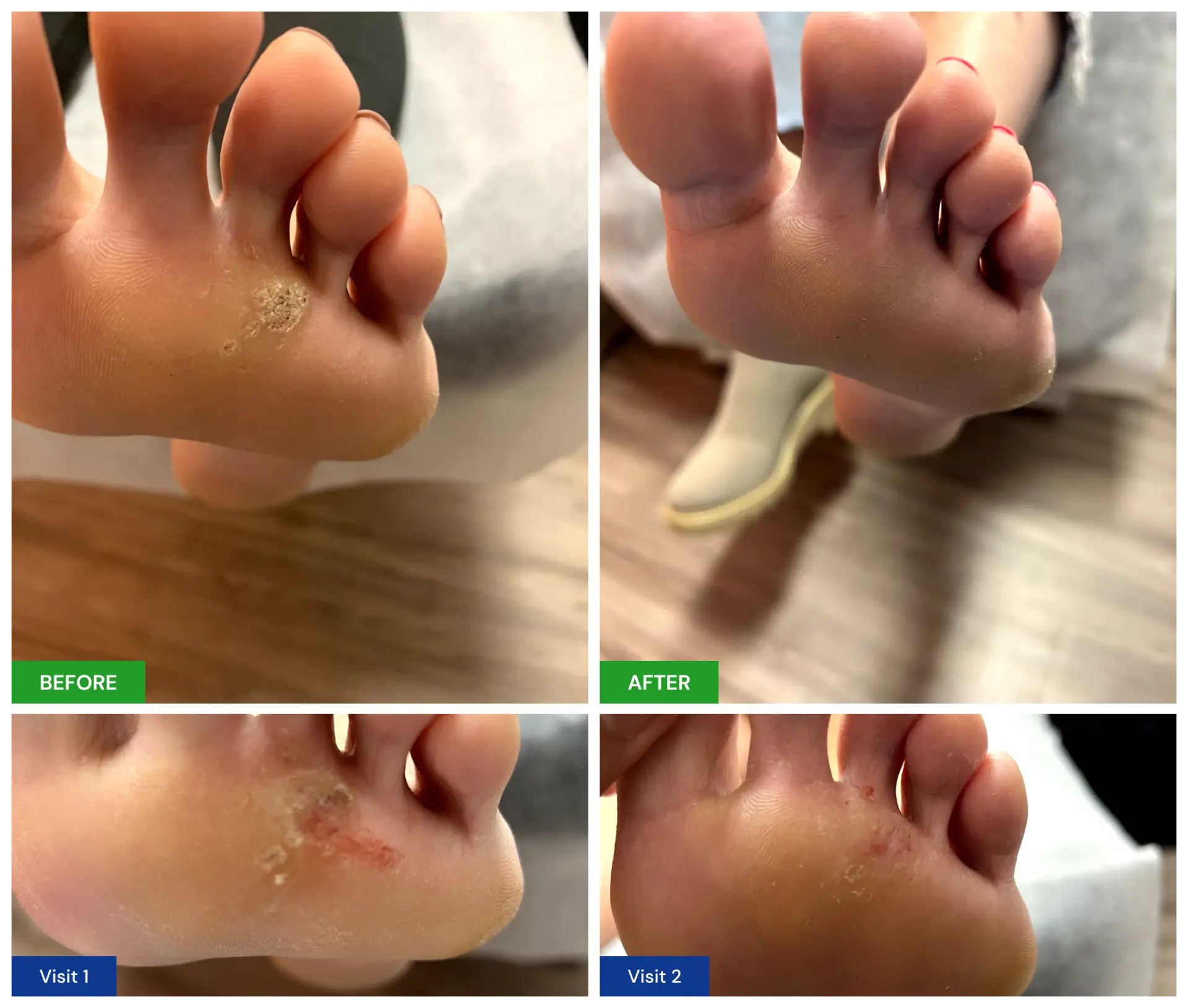 Plantar Wart Treatment New Horizons Foot and Ankle Associates
