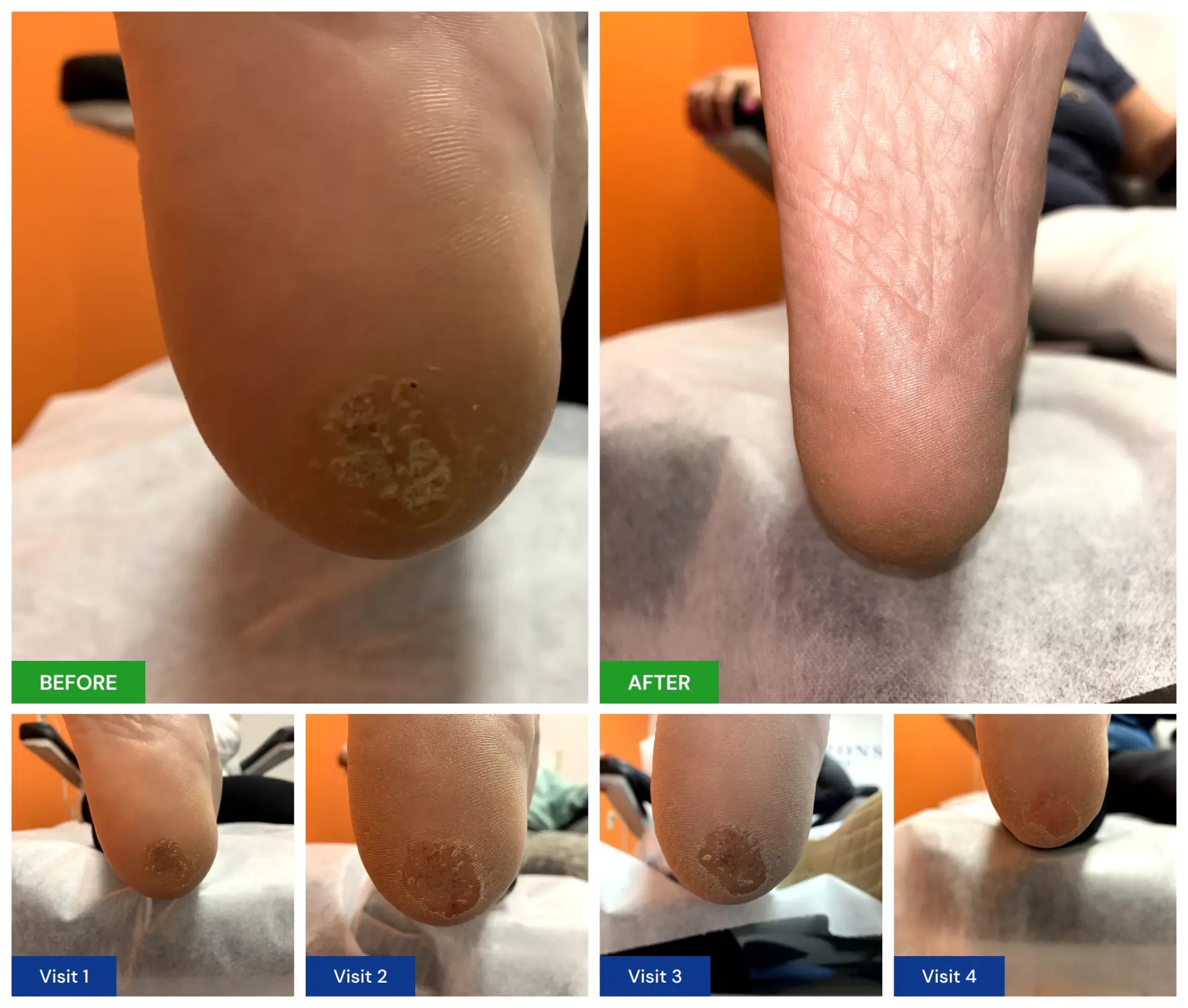 Plantar Wart Treatment New Horizons Foot and Ankle Associates