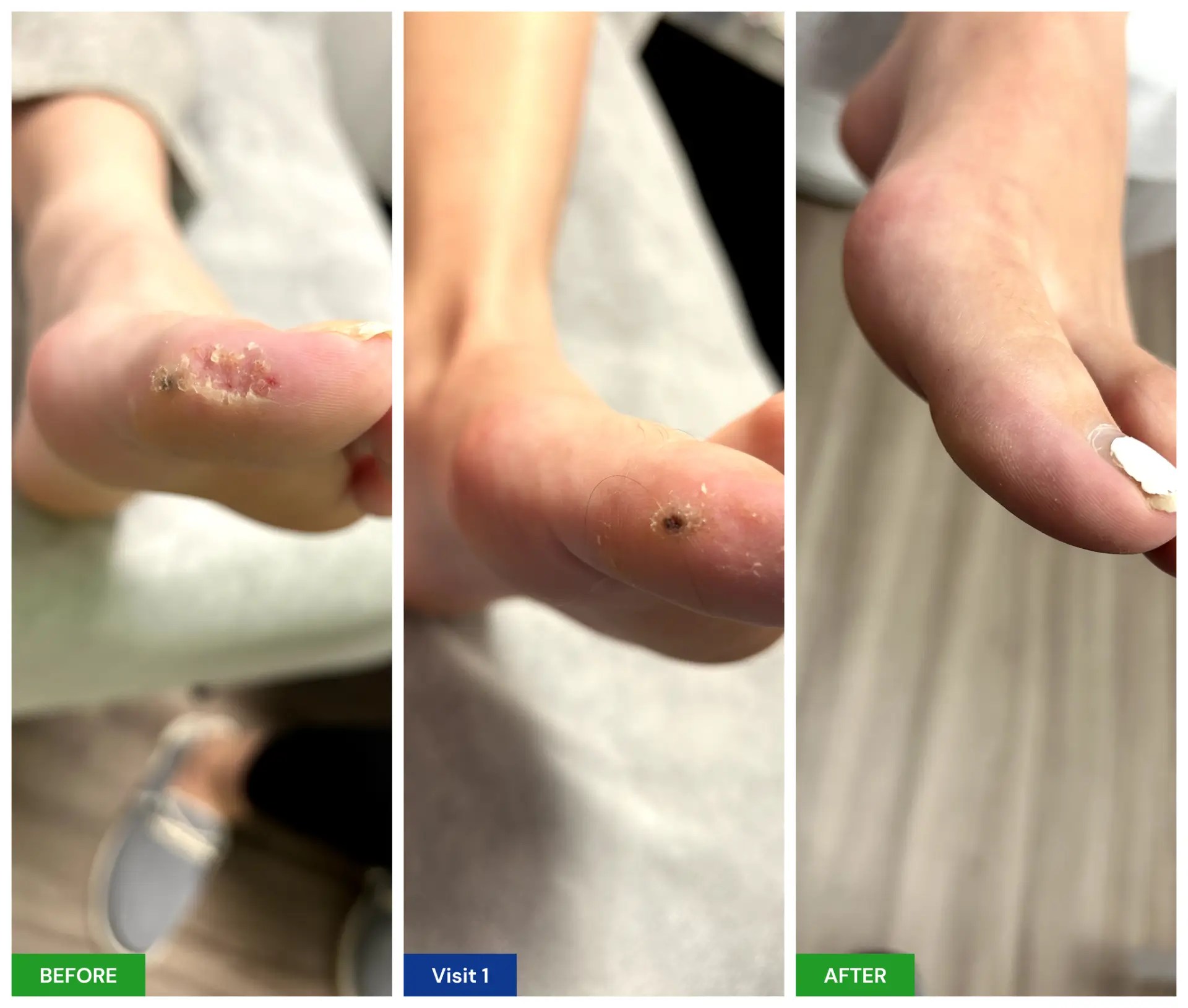 Plantar Wart Treatment New Horizons Foot and Ankle Associates