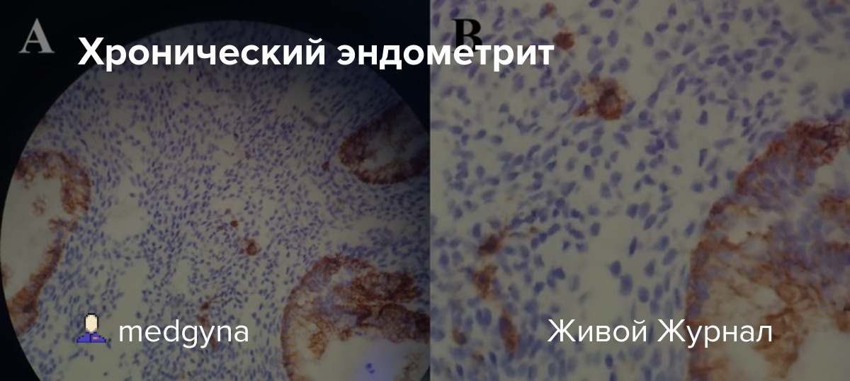 Хронический эндометрит medgyna — LiveJournal