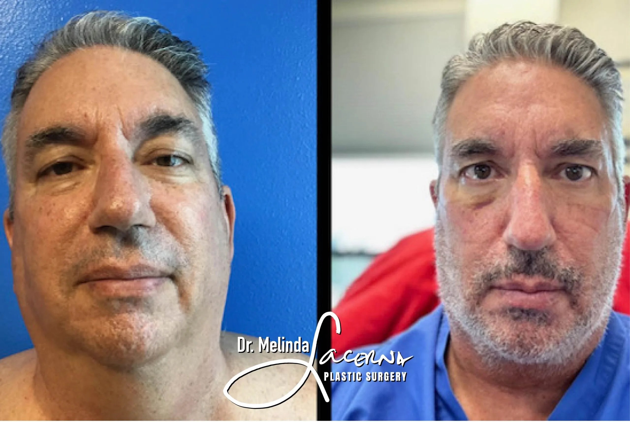 Signature Facelift 12 Before & After Result Photos