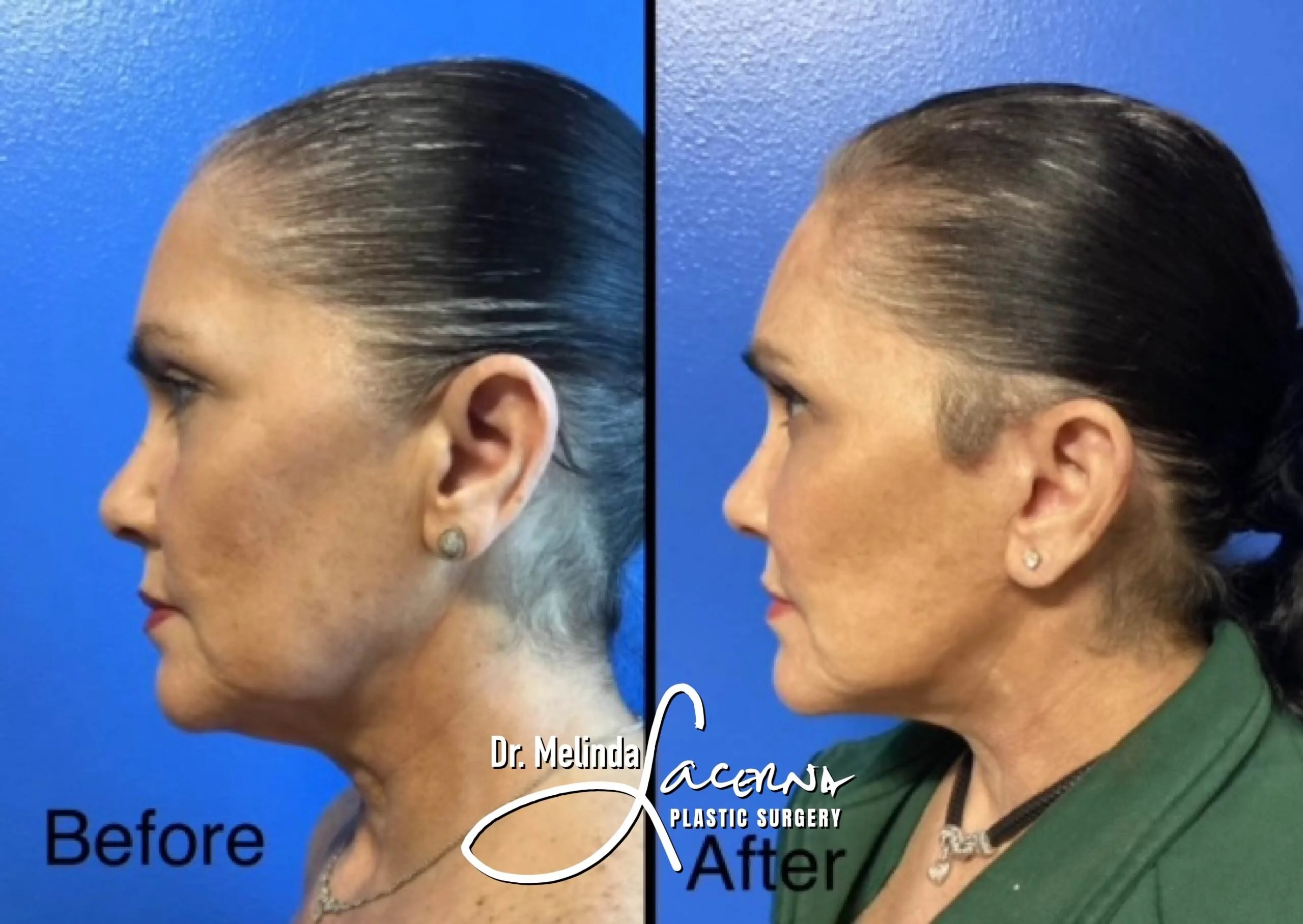 Signature Facelift 8 Before & After Result Photos