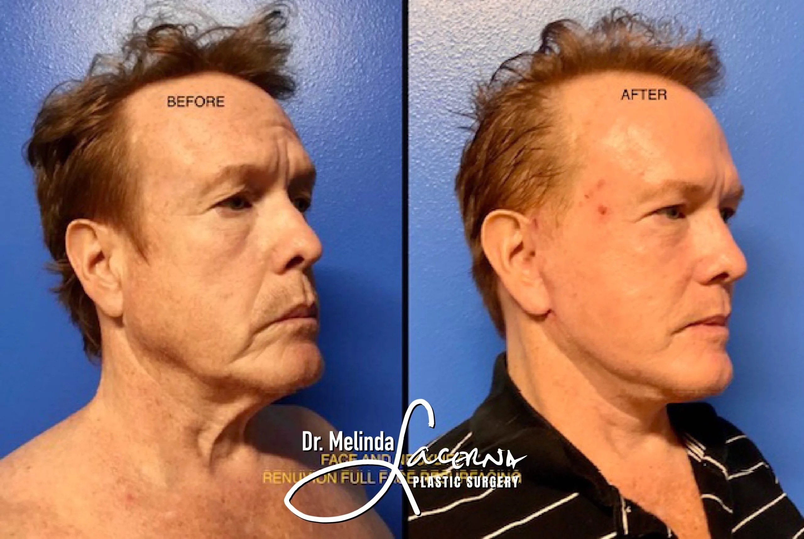 Signature Facelift 9 Before & After Result Photos