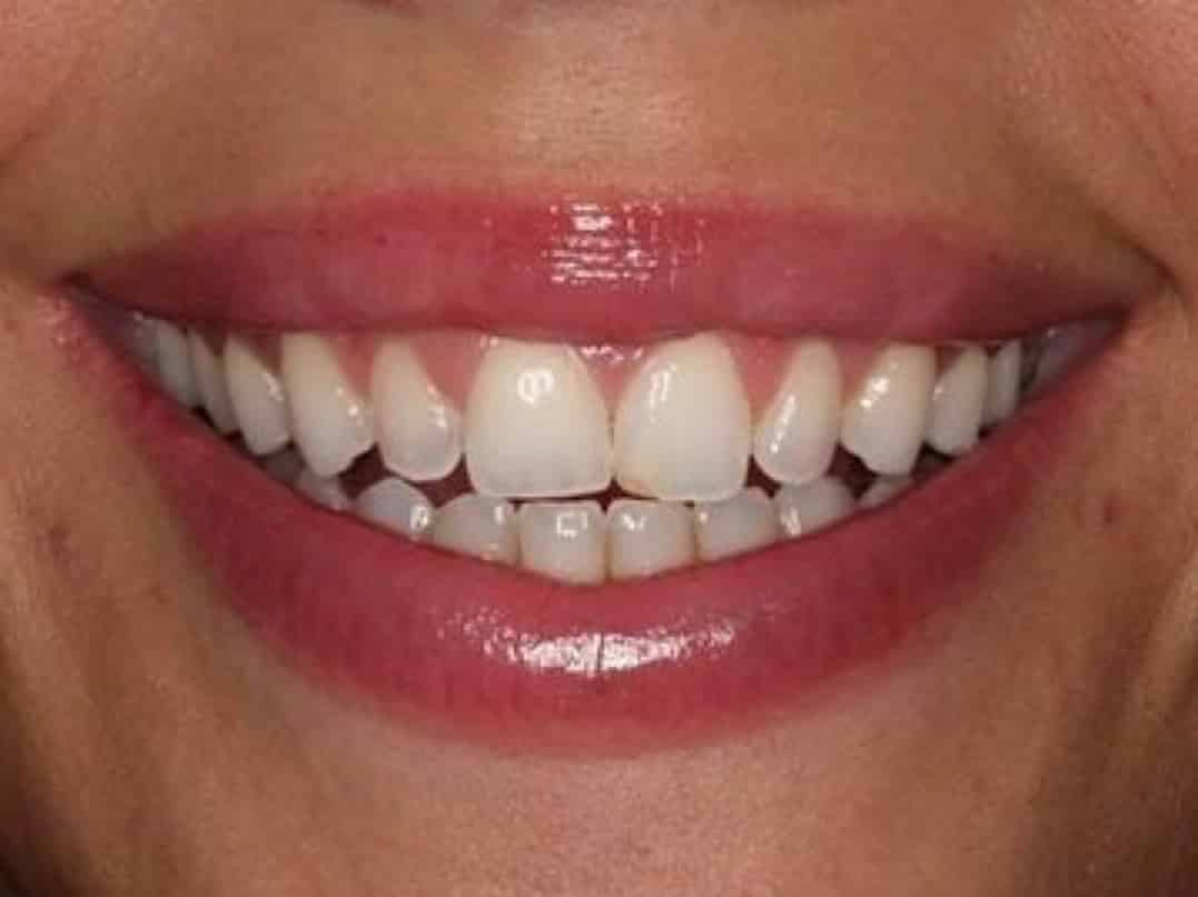 Beverly Hills Veneers LA Beauty Guide