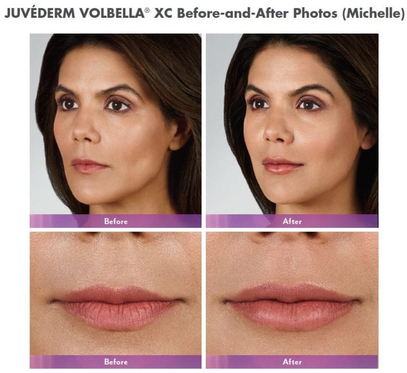 Juvederm Volbella® XC Lip Injection Gel
